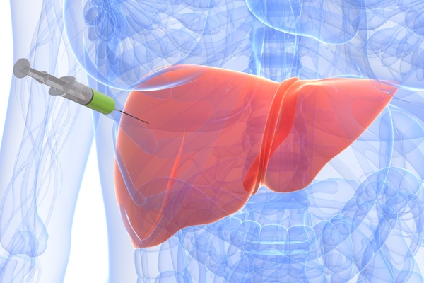 肝脏穿刺活检湘雅专家共识