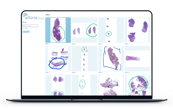 高通量、基于机器学习的NAFLD脂肪变、炎症、气球样变和纤维化量化分析