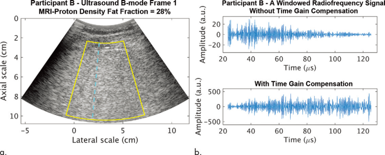 使用一维卷积神经网络的射频超声数据对非酒精性脂肪肝病进行无创诊断和肝脂肪定量